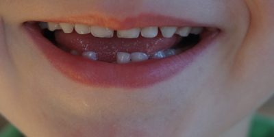 Best Ways to Pull Your Child's Baby Tooth | Vann Family Dental